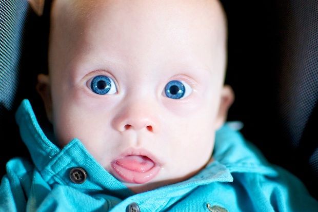 عدم تشخیص کم کاری تیروئید در نوزادان موجب عقب ماندگی ذهنی می شود