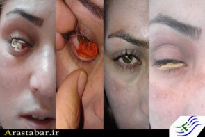 زن اردبیلی که چشمش نخ تولید میکند! +تصاویر