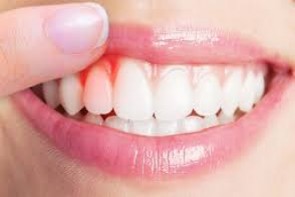 علت و علائم تا راههای درمان طبیعی خونریزی لثه علت و علائم تا راههای درمان طبیعی خونریزی لثه